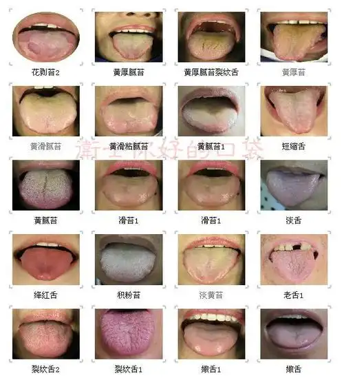 【转载】你也可以做医生:中医常见舌苔图象(组图)