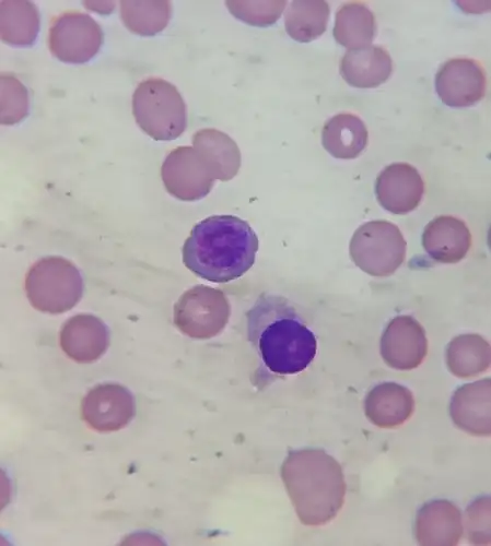 背痛1个多月,到处看不见好,瞄一眼血涂片就知道是啥病,发现了啥?