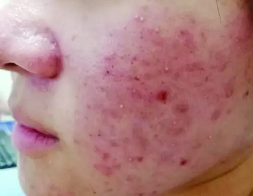 痤疮是比较严重的皮肤病,直接影响"面子"问题.