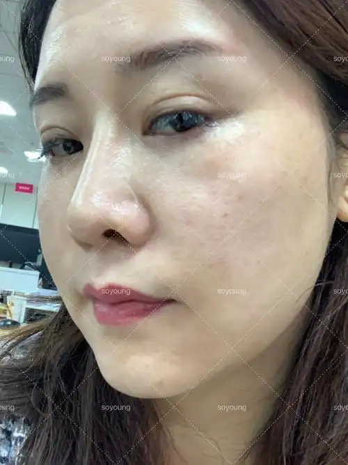 做完光子嫩肤的第一天,效果很不错,我主要是去红血丝_圈子-新氧美容