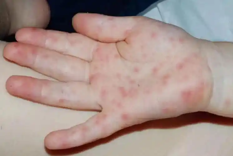手足口病症状初期征兆图片,教你如何辨认手足口水泡 - 医孕帮