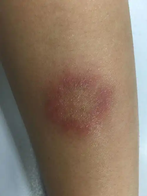 三天前手臂有点痒,抓了一下后红了,然后这两天形成个圈圈一样的红印子