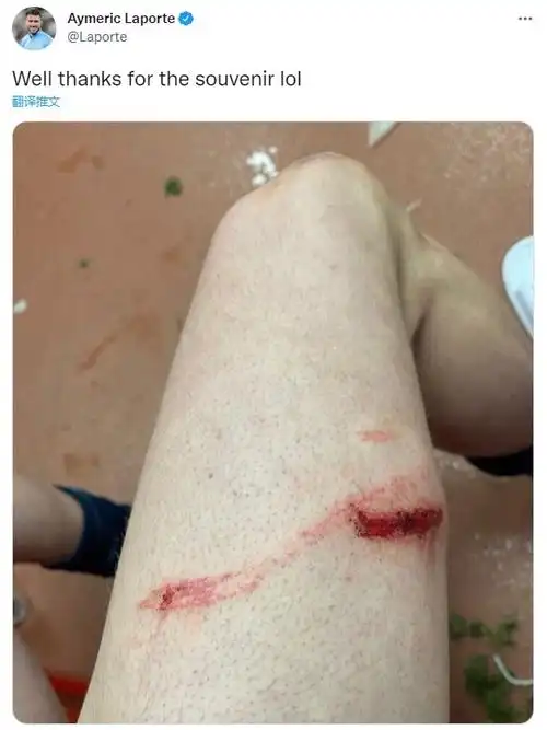 拉波尔特赛后晒大腿伤口:谢谢你送的纪念品,哈哈|曼城|拉波尔特_新浪