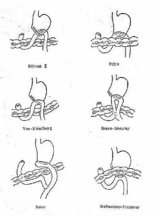 billroth Ⅱ式胃空肠吻合的不同方法