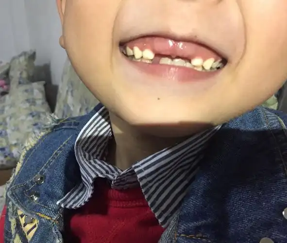 8岁小孩门牙掉5个月还没长,门龈看感觉有点肿,不疼