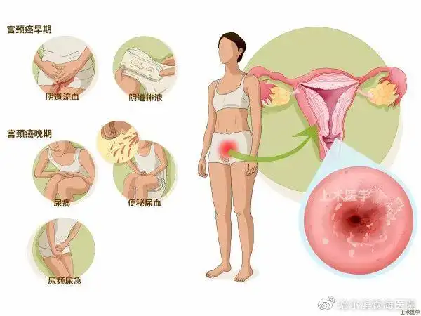 这3个症状可能是宫颈癌的早期信号