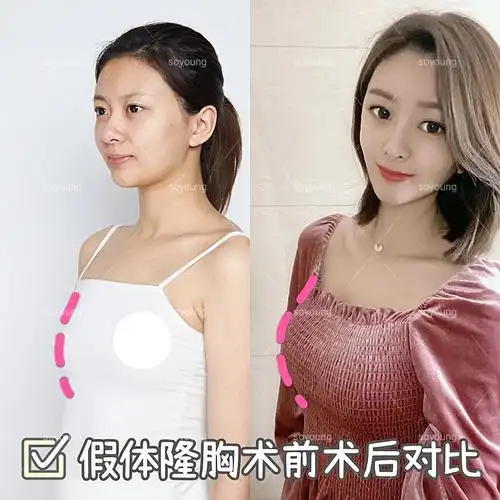 广州曙光假体隆胸术前术后对比