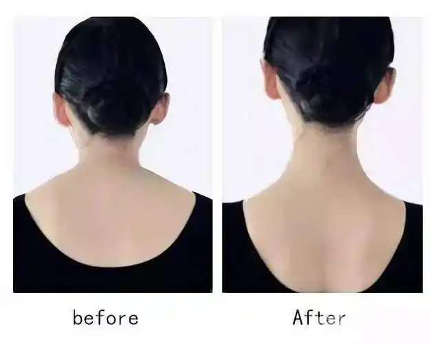 荆州瘦肩针多少钱一只?_荆州中心医院整形美容科