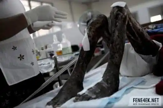 艾滋病晚期痛苦吗