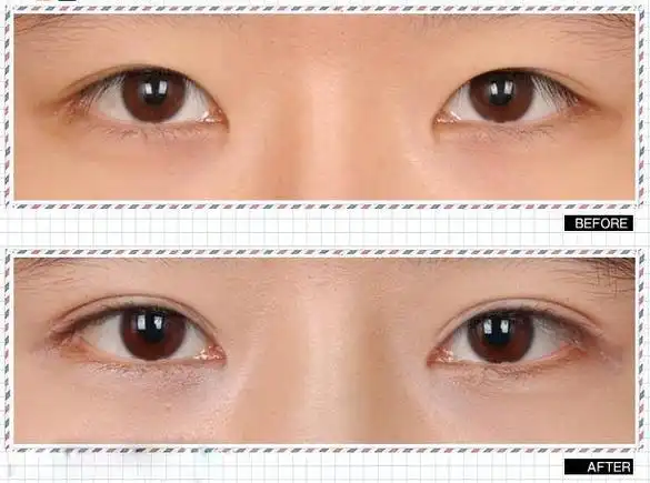埋线双眼皮后7-10天就可修复