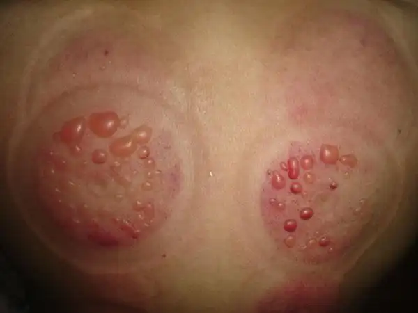 姥姥拔罐,后背皮肤出现深色和粉红色水泡,该怎么办呢?