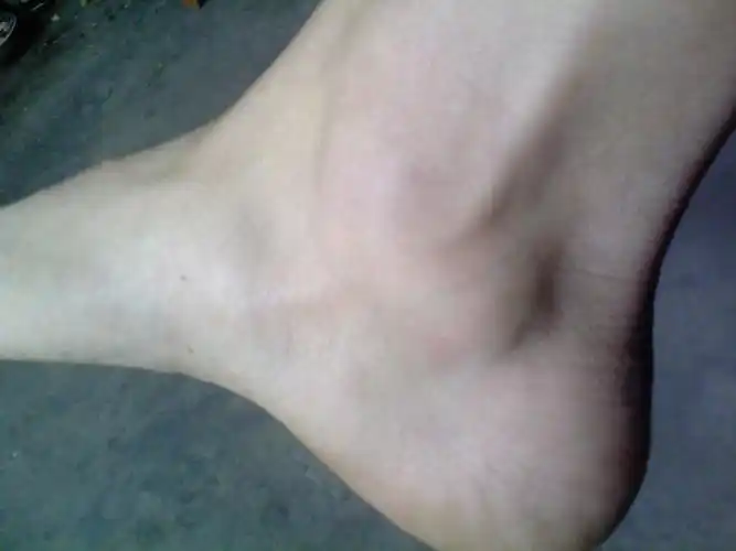 脚踝内侧有个疙瘩 如图 也不疼 不会影响以后的生活吧