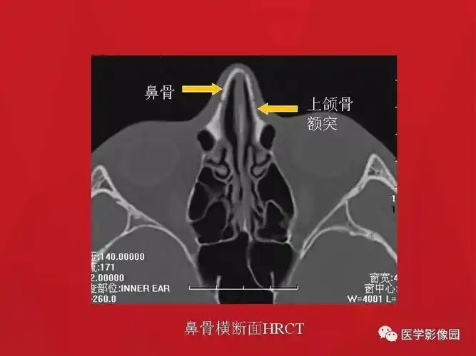 鼻骨骨折影像学诊断与鉴别 | 影像天地