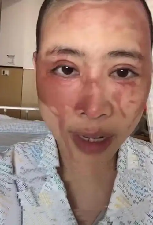 在卫生间中将事先准备好的硫酸泼向她的脸部和头部