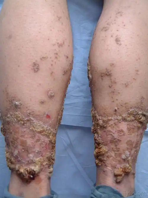 毛囊角化病图片