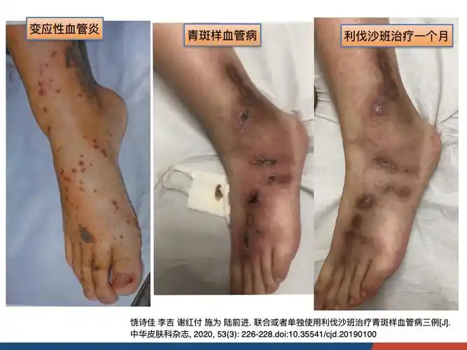青斑样血管病_周围血管病_周围血管病介绍 - 好大夫在线