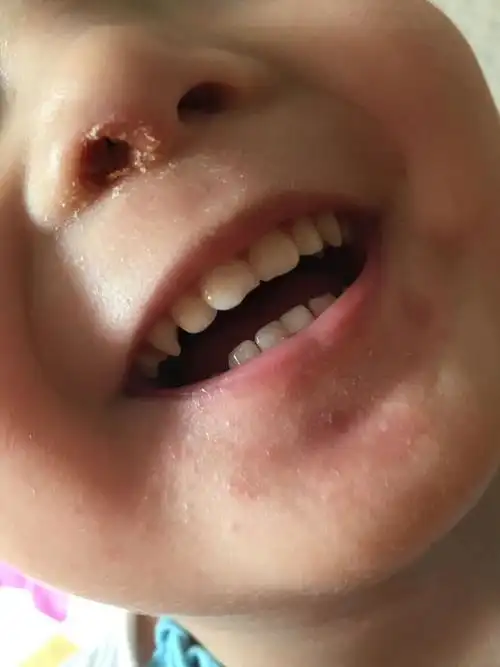 宝宝鼻子里有渗出,结成疙瘩怎么回事