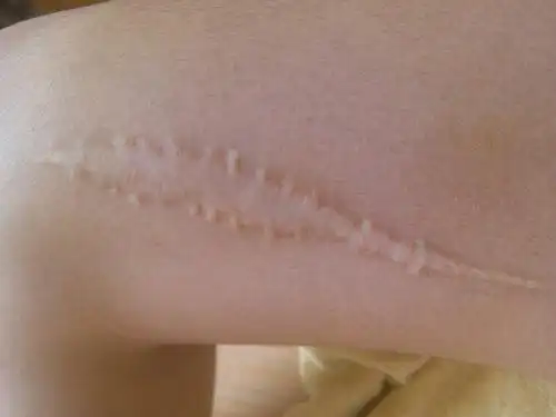 腿上有刀疤能参军吗?