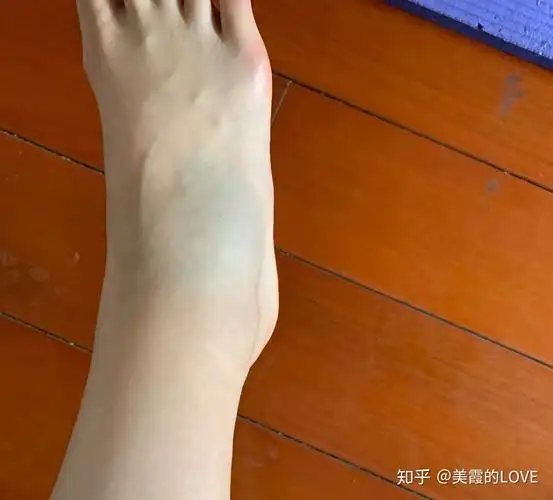 下楼梯崴着脚治疗记