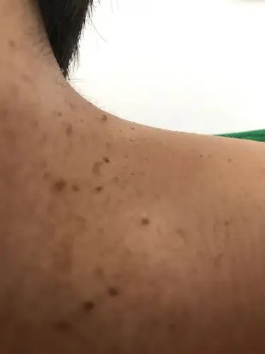 请问一下,脖子上长了很多这样的小肉疙瘩,小米粒那么大吧.不疼也不痒.