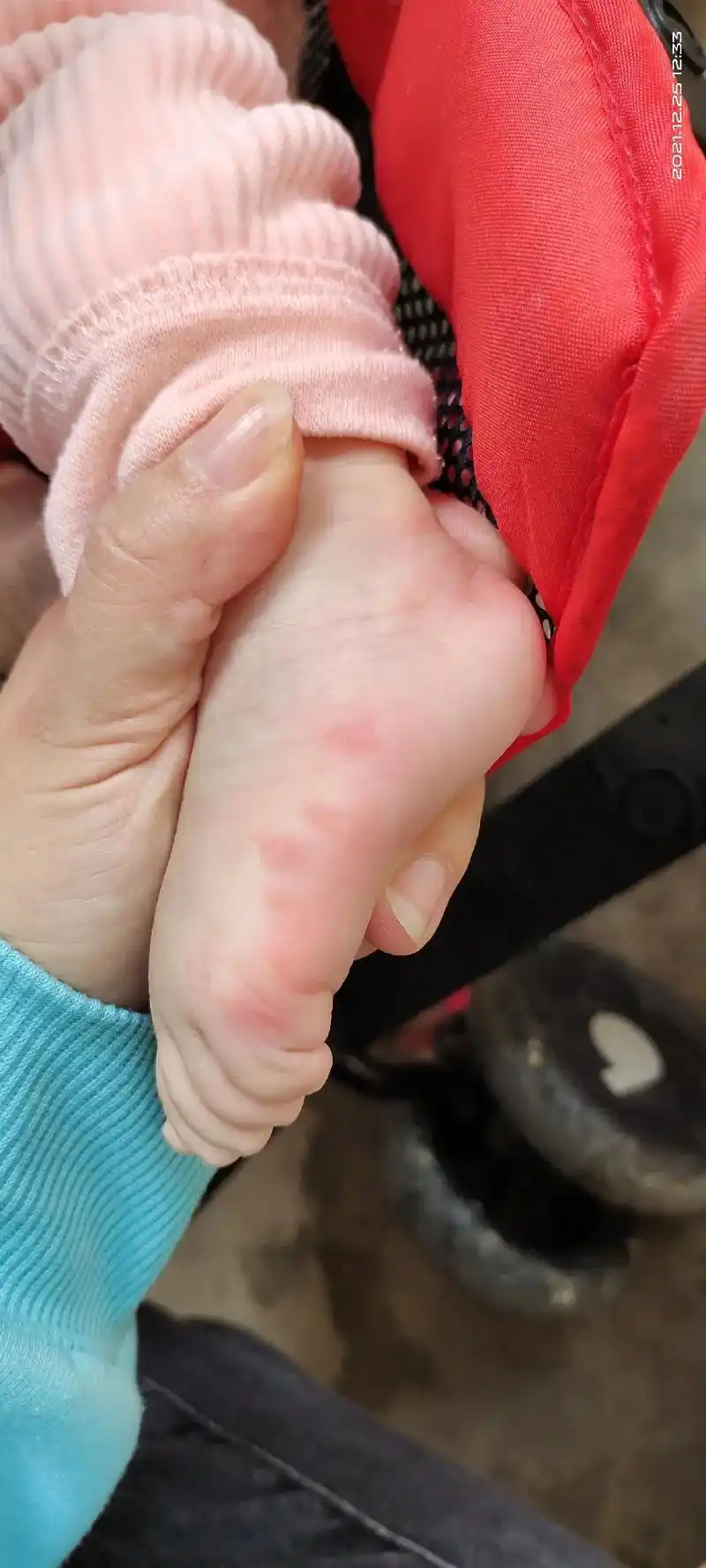 脚上的起水泡泡,脸上红红的,上次是身上起水泡泡去拿药吃了第二 - 抖