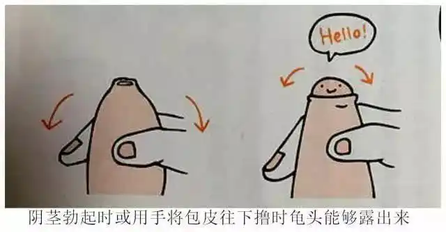 过长的包皮如果能够完全翻起来,就不是包茎;如果包皮口无法翻开,那么