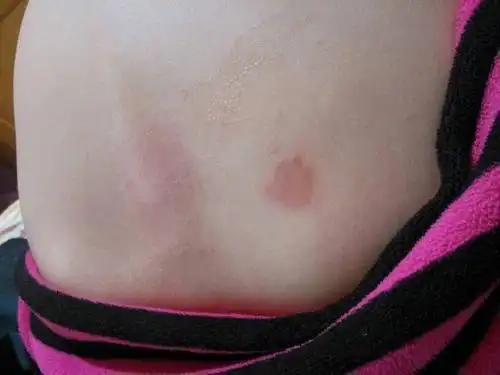 背上长的,看上去像藓一样的东西,很痒,想问问是什么,是什么导致的.