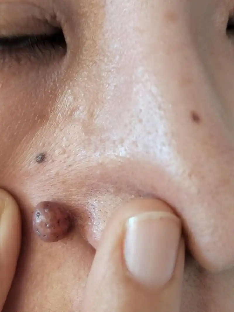 激光治疗色素痣后五天图片.