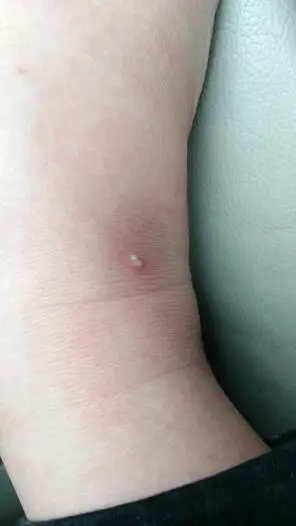 被蚂蚁咬了,该怎么办