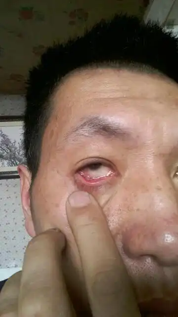 我的眼睛下眼皮内部出现透明的类似黏膜一样的堆积,这是视网膜脱落吗?