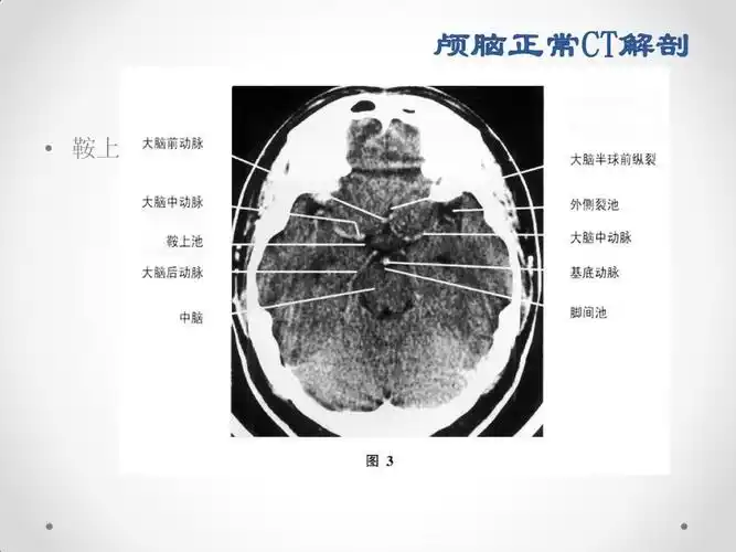 医学影像学 头颅 ct 头部ct解剖及诊断基础 颅脑正常ct解剖   鞍上池