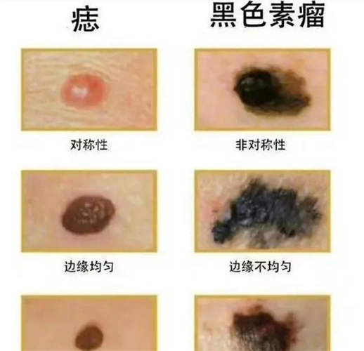 医生科普:黑色素瘤扩散快 数月就能致死