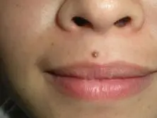 「痣相」解读有双生痣的人命运,你有没有这颗痣?_人中_生育_子宫