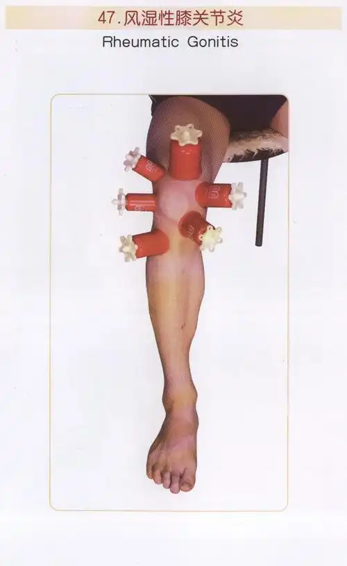 大腿膝盖拔罐位置视频