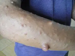 恶性神经纤维瘤大腿部位如何治疗