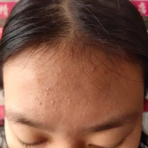 治疗闭合性粉刺