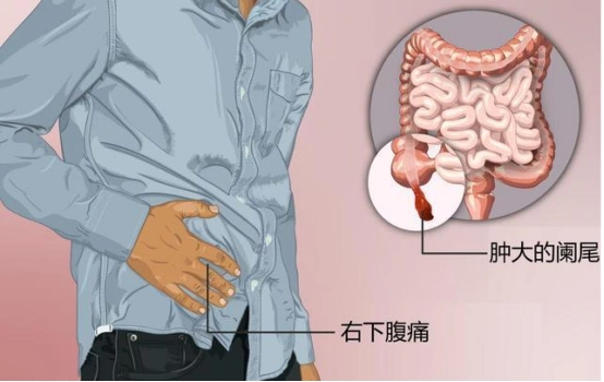 67而组织病理学检查是诊断阑尾癌的金标准,阑尾癌不仅容易向结肠,回