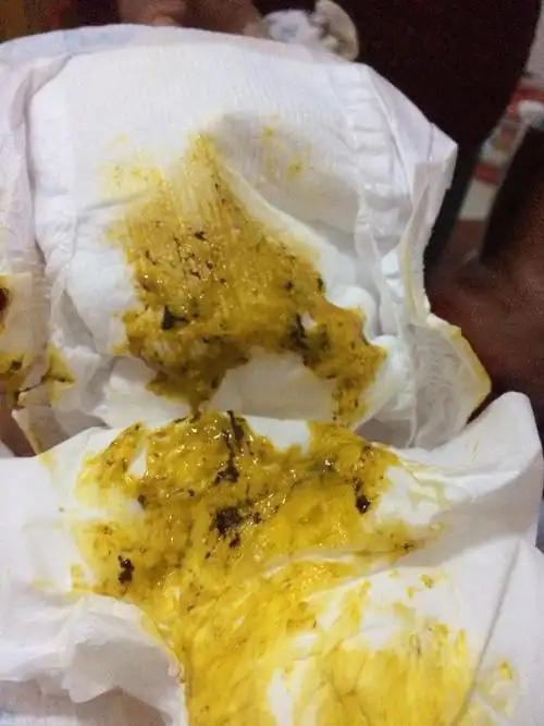 宝宝刚刚拉的臭臭,里面有点黑色的不知道是什么?