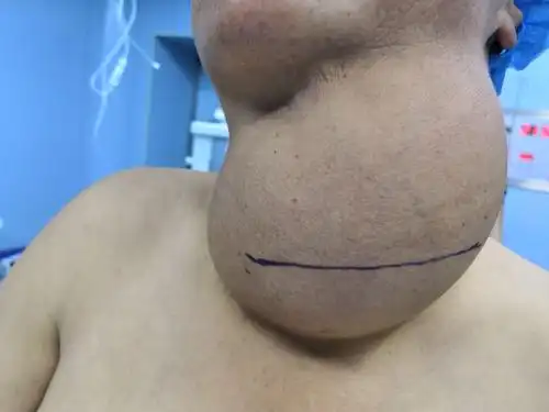 勉县医院多科协做,成功切除一巨大甲状腺瘤