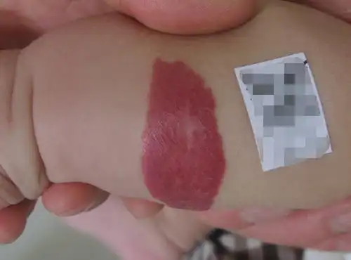 济南胎记血管瘤医院:血管瘤的危害哪些