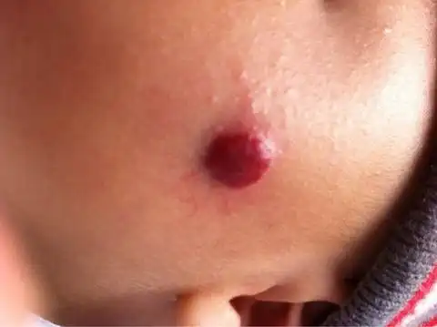 【专家支招】如何判断婴儿血管瘤是否会消退?