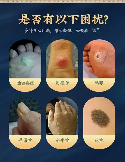扁平疣尖锐湿疣去丝状疣寻常疣去肉粒刺猴子去疣脖子颈部必治可搭5