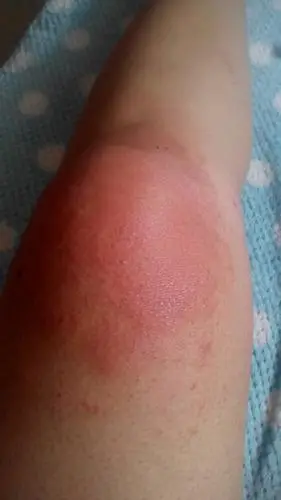 腿部贴膏药起红疹子,红肿,怎么办?见效快?抹了中药膏没怎么效果.