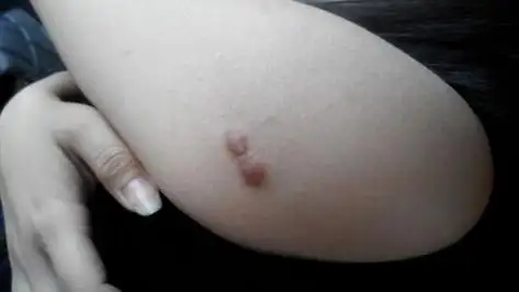 肛门长肉疙瘩会自己恢复吗不疼