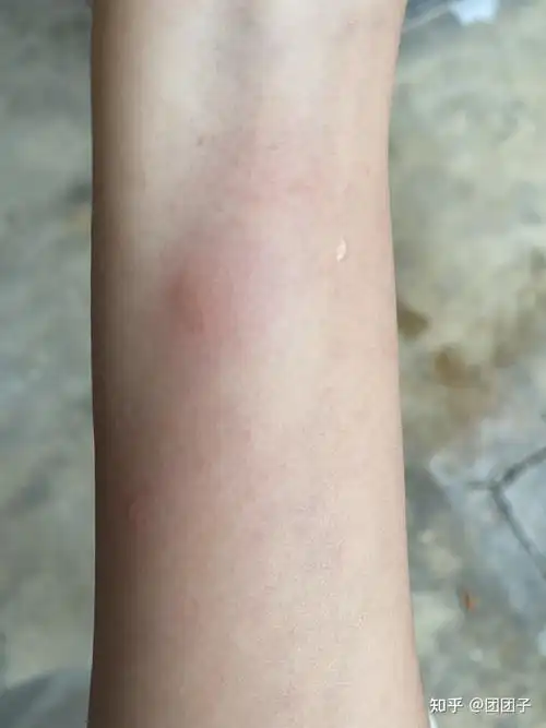 护士说让我明天去挂急诊,说什么都有水泡了,好慌!有没有人能看出来啊?