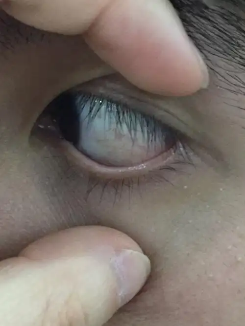 眼白有黄色透明果冻状物_王飞_主治医师_爱问健康