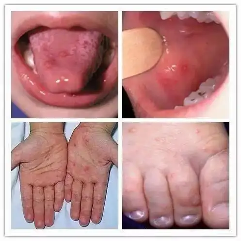 ▌特征表现 除此之外,手足口病还具有一些特征表现.