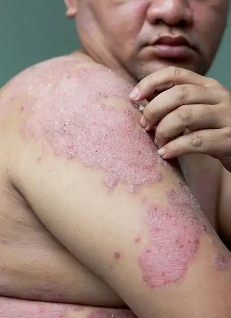 各种皮炎症状图片大全_银屑病求医网