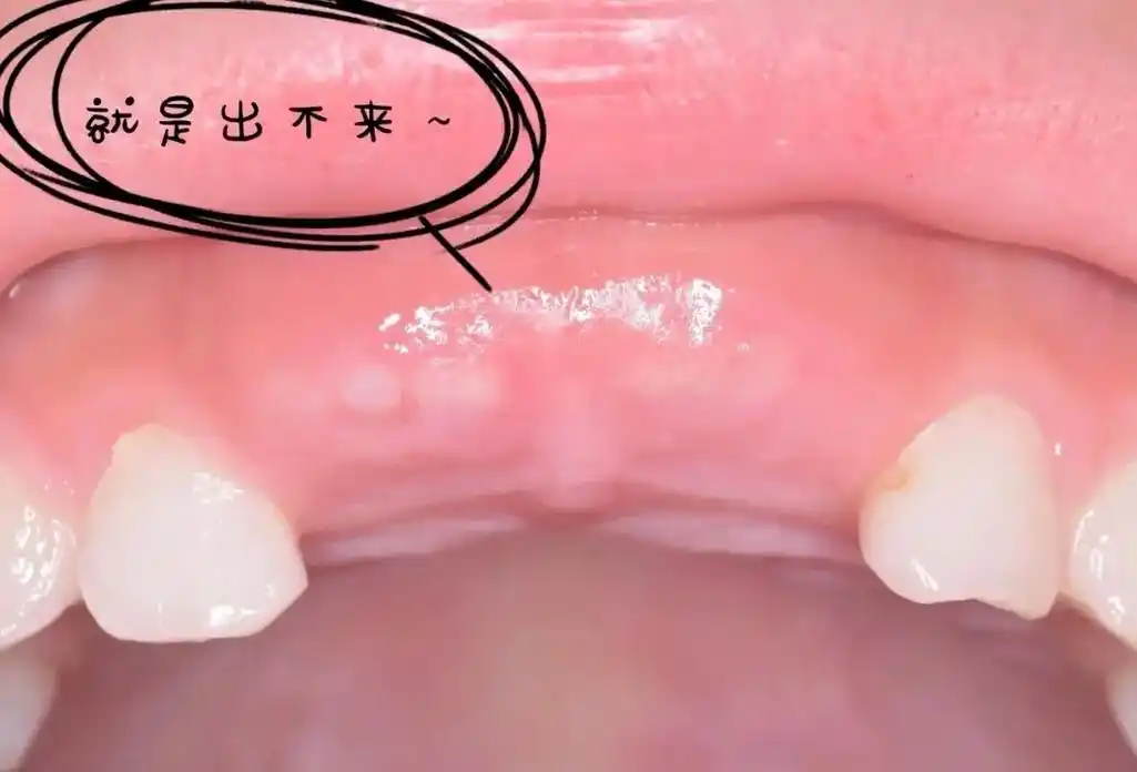 什么是开窗助萌?开窗助萌是指儿童更换牙齿的时间 - 抖音
