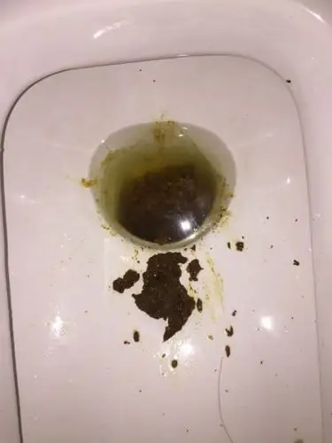 这种大便是黑便吗?肠癌拉出来的大便是这种吗?